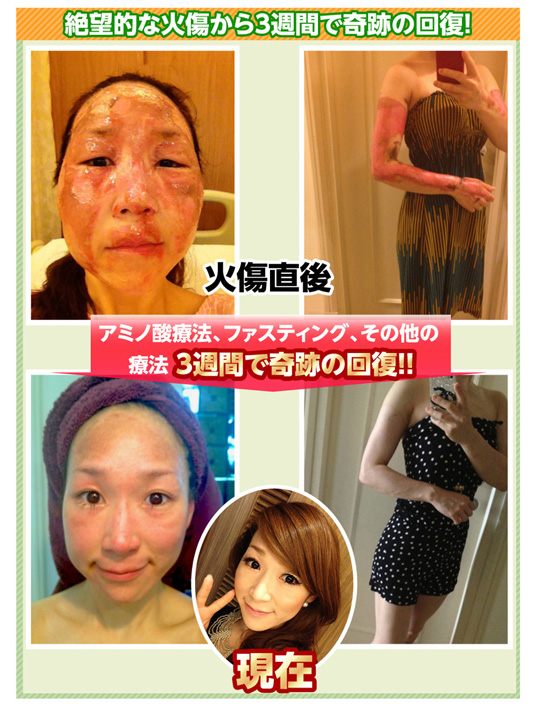 絶望的な火傷から3週間で奇跡の回復！