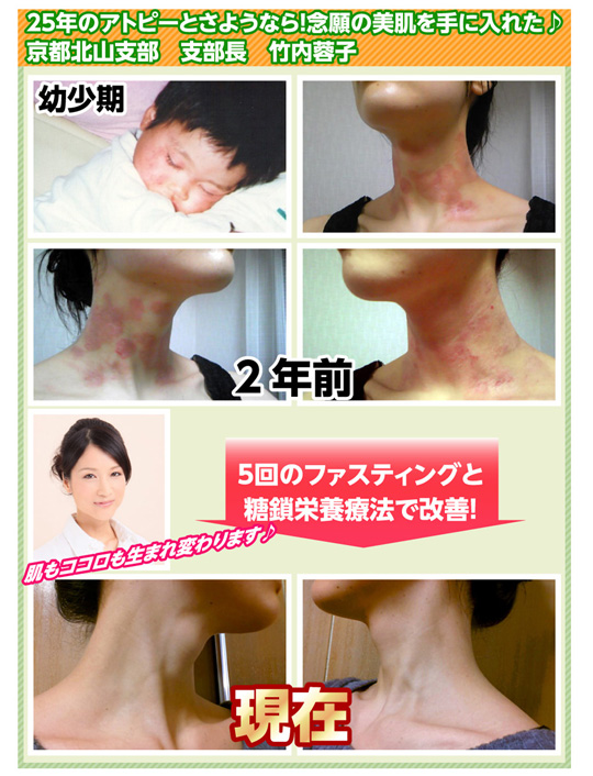 25年のアトピーとさようなら！念願の美肌を手に入れた♪